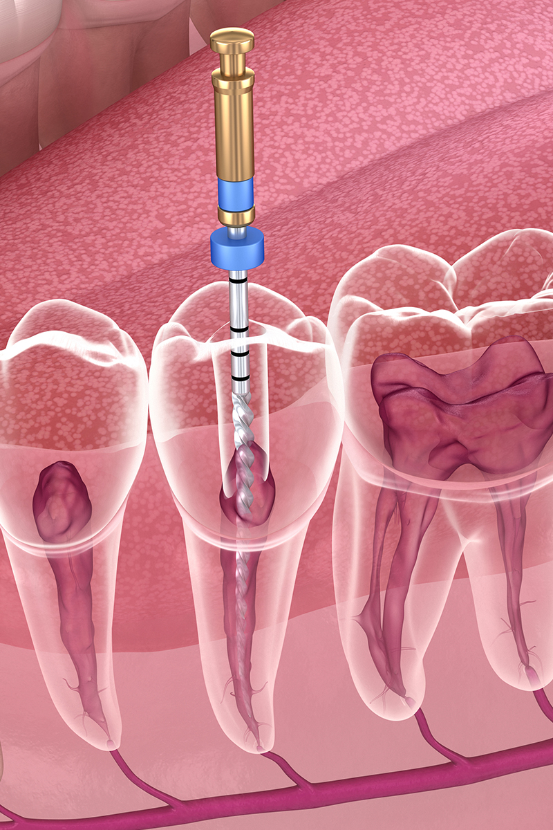 endodonzia